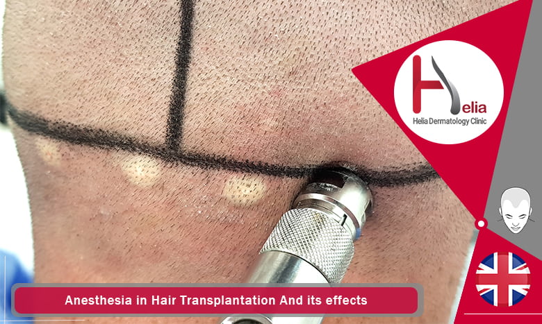 Anesthesia in Hair Transplantation And its effects