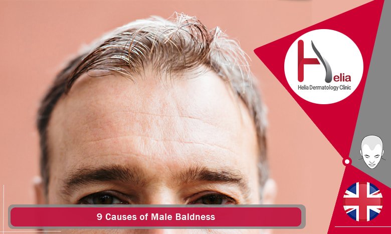 Causes of Male Baldness