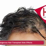 Dangerous Hair Transplant Side Effects