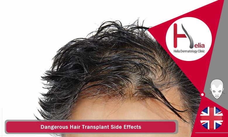 Dangerous Hair Transplant Side Effects