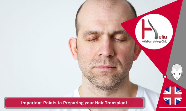 Important Points Before Hair Transplant