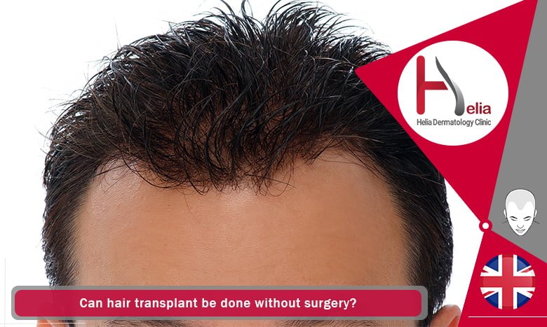 Can Hair Transplantation Be Done Without Surgery? Cons And Durability -  Helia Clinic