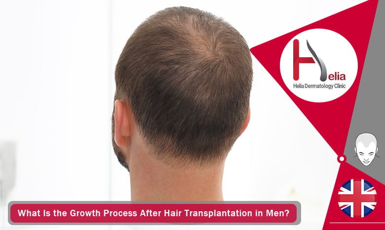 What Is the Growth Process After Hair Transplantation in Men?
