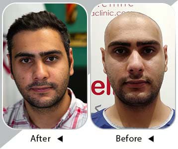Acceptable result of natural hair transplant