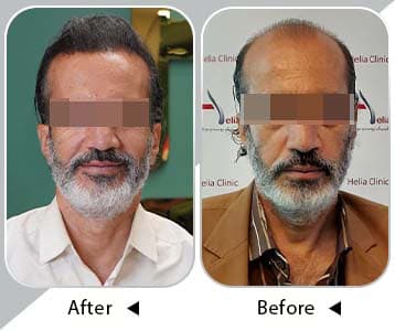 Before and after Helia Clinic natural hair transplant