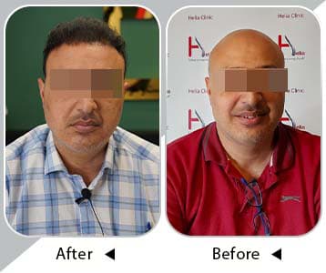 Before and after hair implant