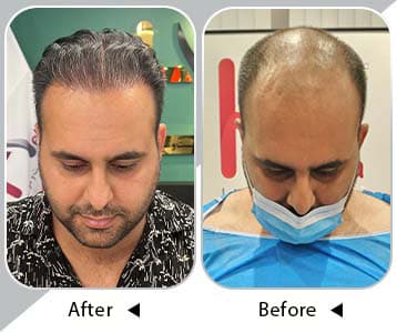 result of micrograft hair transplantation