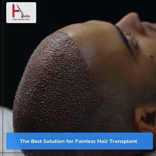 FUE Hair Transplant: The Best Solution for Painless Hair Transplant