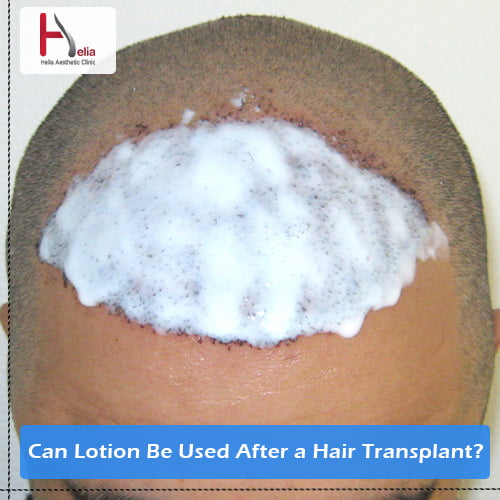Can Lotion Be Used After a Hair Transplant?
