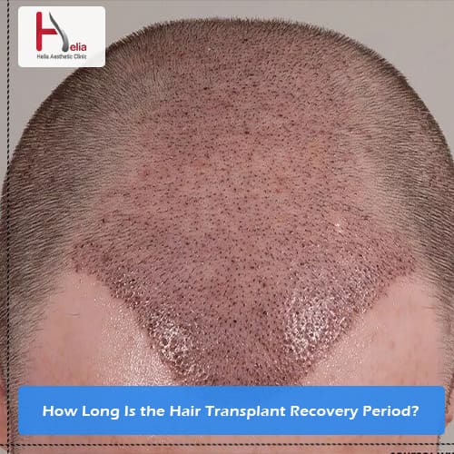 How Long Is the Hair Transplant Recovery Period?