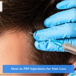How to PRP Injections for Hair Loss