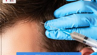 How to PRP Injections for Hair Loss