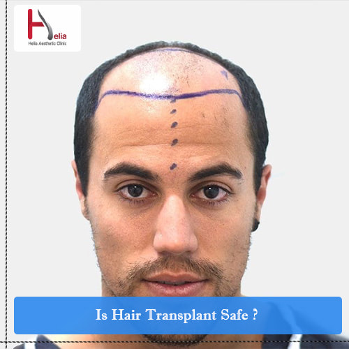 Is Hair Transplant Safe?