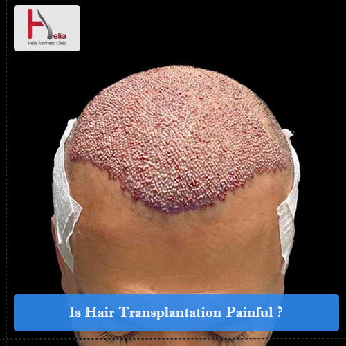 Is Hair Transplantation Painful?