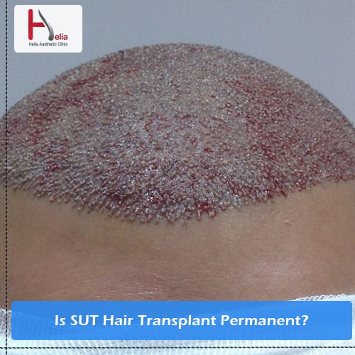 Is SUT Hair Transplant Permanent?