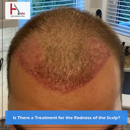 Is There a Treatment for the Redness of the Scalp?