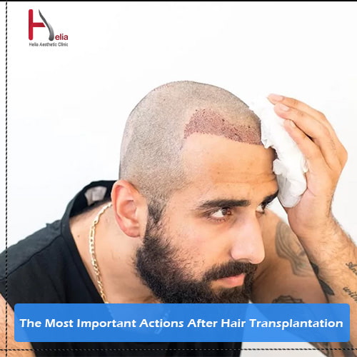 The Most Important Actions After Hair Transplantation