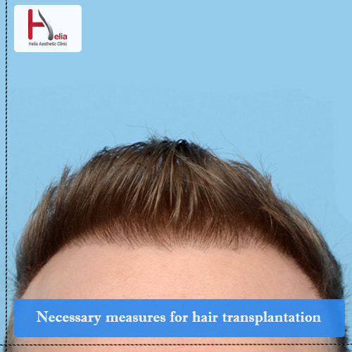 Necessary measures for hair transplant
