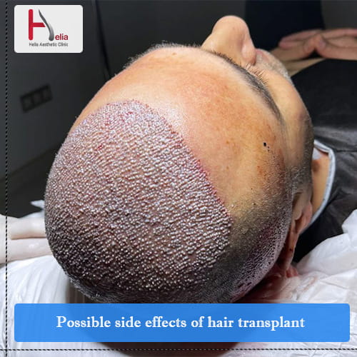Possible side effects hair transplant