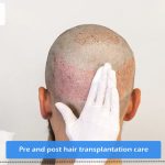 Pre and post hair transplantation care