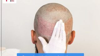 Pre and post hair transplantation care