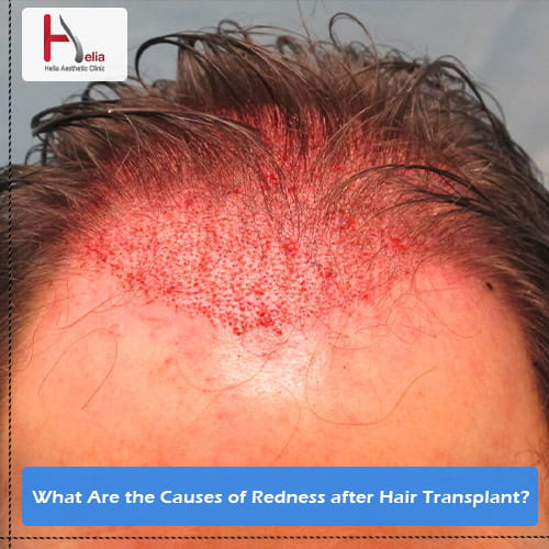What Factors Cause Greasy Hair after Hair Transplantation?