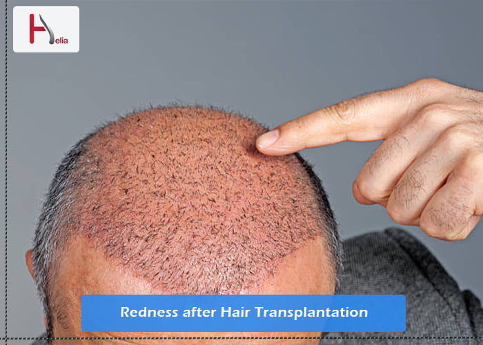 Redness after Hair Transplantation