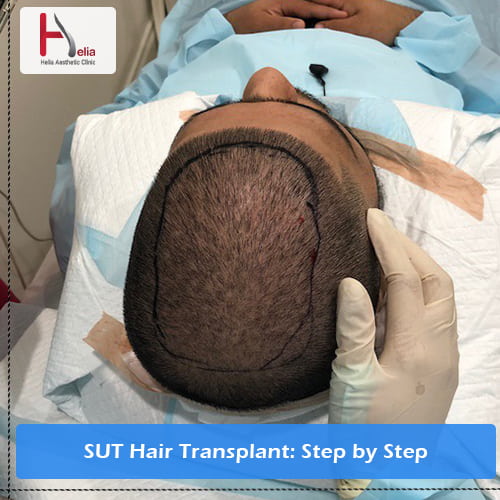 SUT Hair Transplant: Step by Step