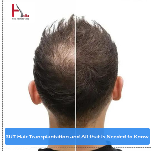 SUT Hair Transplantation and All that Is Needed to Know