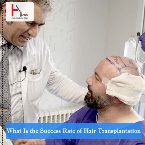 What Is the Success Rate of Hair Transplantation?