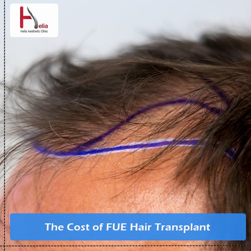 The Estimated Cost of FUE Hair Transplant