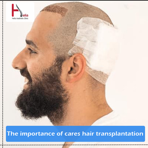 The Importance of Cares Before and After Hair Transplantation