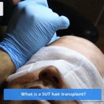 What is a SUT hair transplant?