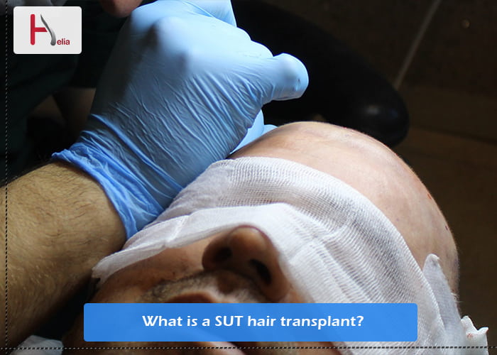 What is a SUT hair transplant?