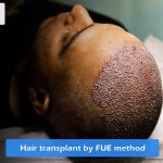 hair transplantation by FUE method