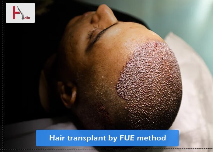 hair transplantation by FUE method