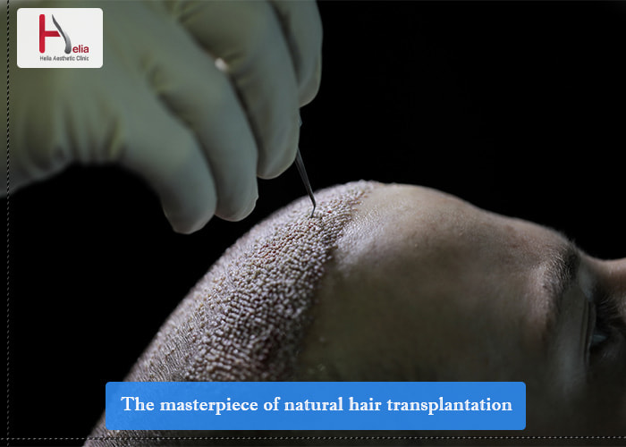 The masterpiece of natural hair transplantation 2023