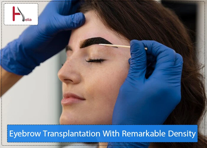 Eyebrow Transplantation With Remarkable