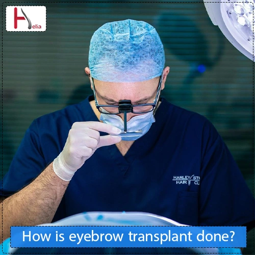 How does eyebrow transplantation work and who is it for?