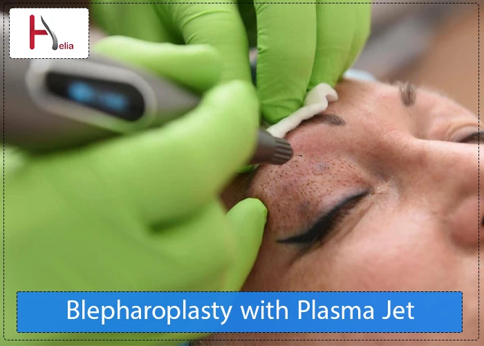 Blepharoplasty with Plasma Jet