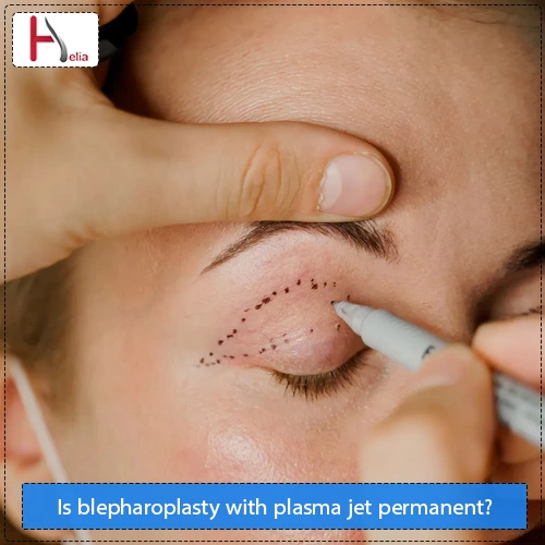 Is blepharoplasty with plasma jet permanent?
