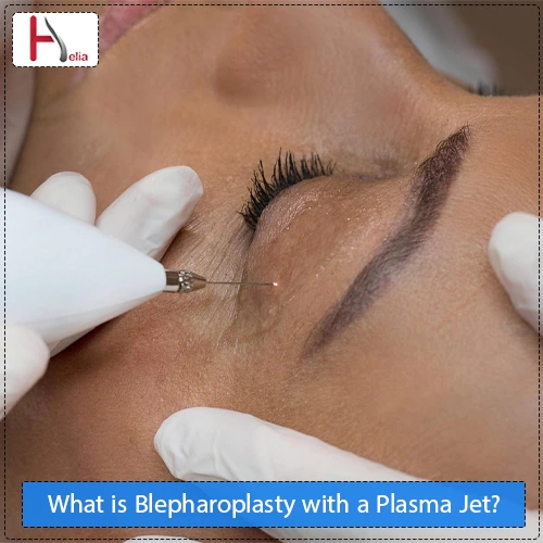 What is Blepharoplasty with a Plasma Jet?