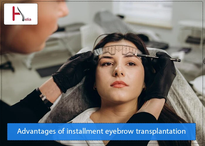 Benefits of installment eyebrow transplant