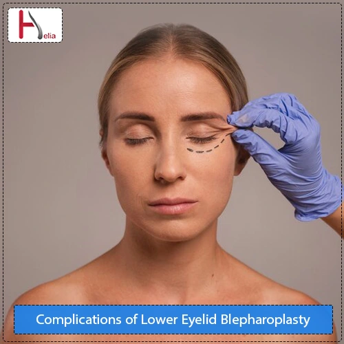 Complications of Lower Eyelid Blepharoplasty