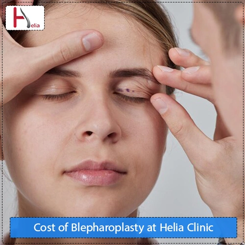 Cost of Blepharoplasty at Helia Clinic