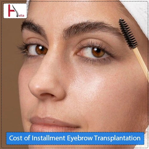 Cost of Installment Eyebrow Transplantation