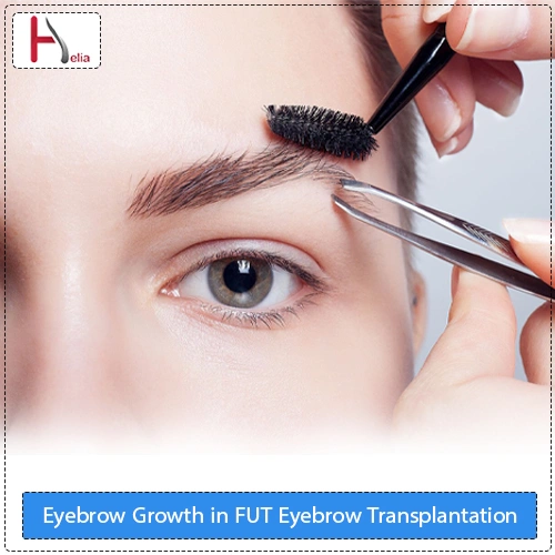 Eyebrow Growth in FUT Eyebrow Transplantation