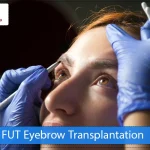 FUT Eyebrow Transplantation