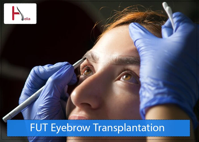 FUT Eyebrow Transplantation