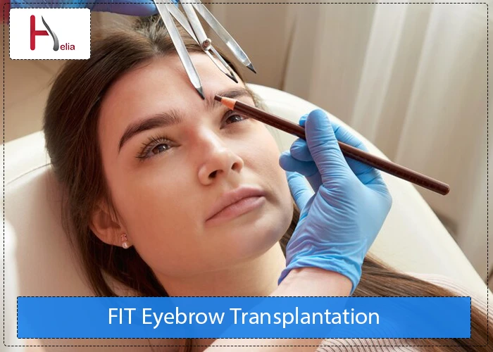 FIT Eyebrow Transplantation